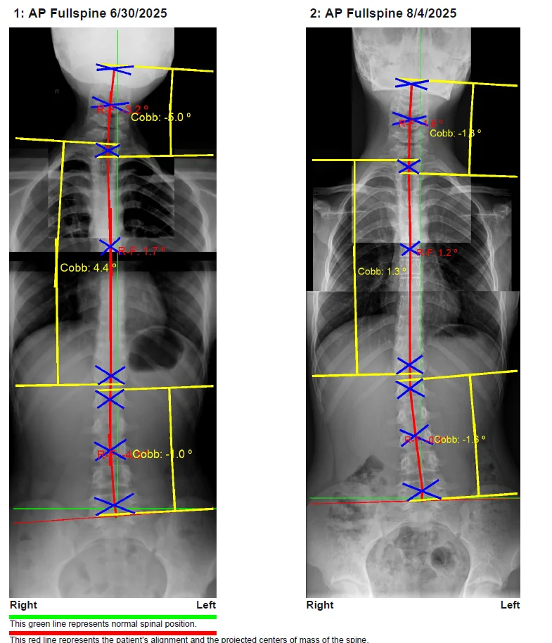 Before and after AP Full Spine structural correction X-ray