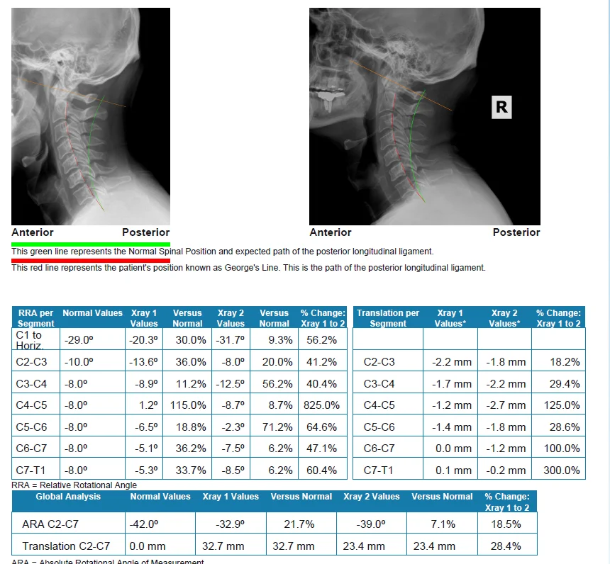 Before and after Lateral Cervical X-ray showing correction of forward head posture and lordosis