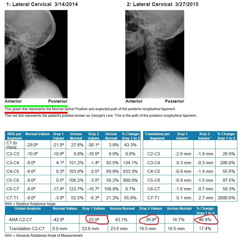 Before and after Lateral Cervical X-ray showing restoration of the neck curve after whiplash