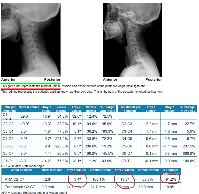 Before and after Lateral Cervical X-ray showing structural correction to relieve tension headaches and migraines