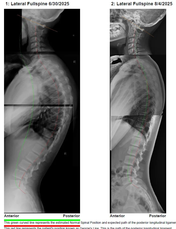 Before and after Lateral Full Spine posture correction X-ray