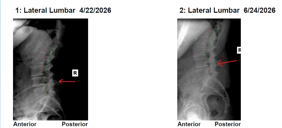 Before and after Lumbar X-ray showing structural correction and reduction of retrolisthesis to relieve disc pressure