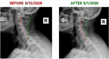 Individual Case 005 before-and-after cervical imaging demonstrating measured changes in cervical alignment